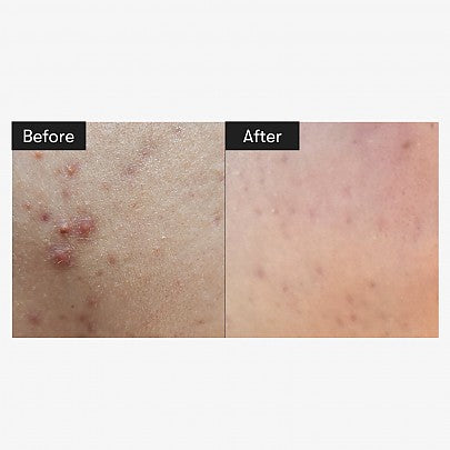 VT COSMETICS - VT Reedle Shot 100